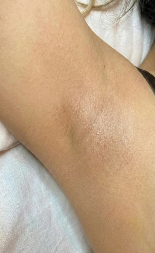 Epilare definitiva axila dupa.