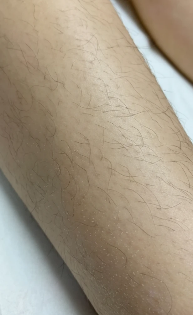 Epilare definitiva gamba inainte.