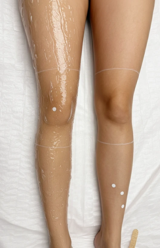 Tratamente de epilare definitiva laser realizate cu grija si profesionalism